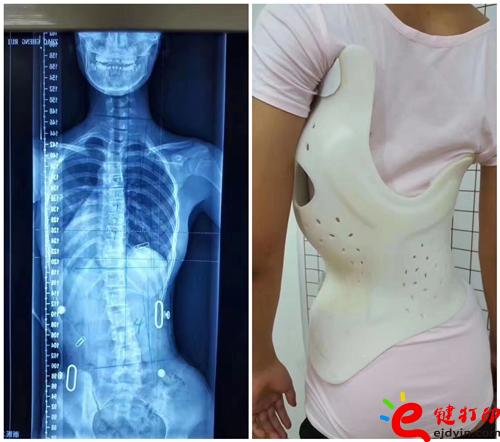 3D打印脊柱粒子導(dǎo)板