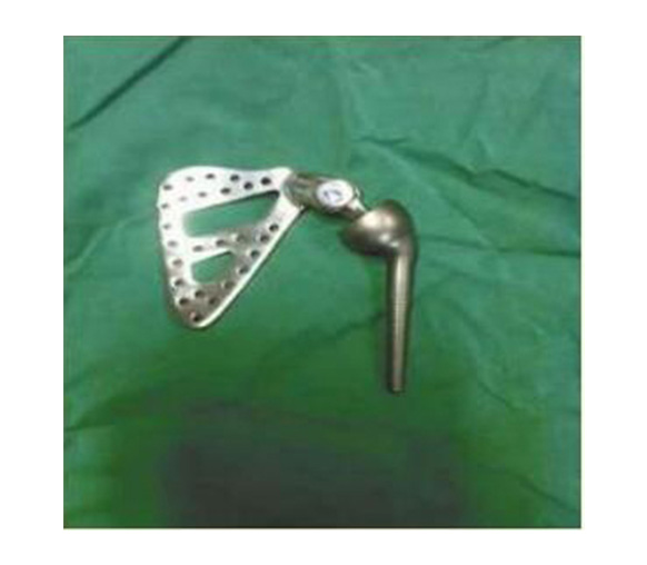 肩關(guān)節(jié)金屬植入物1